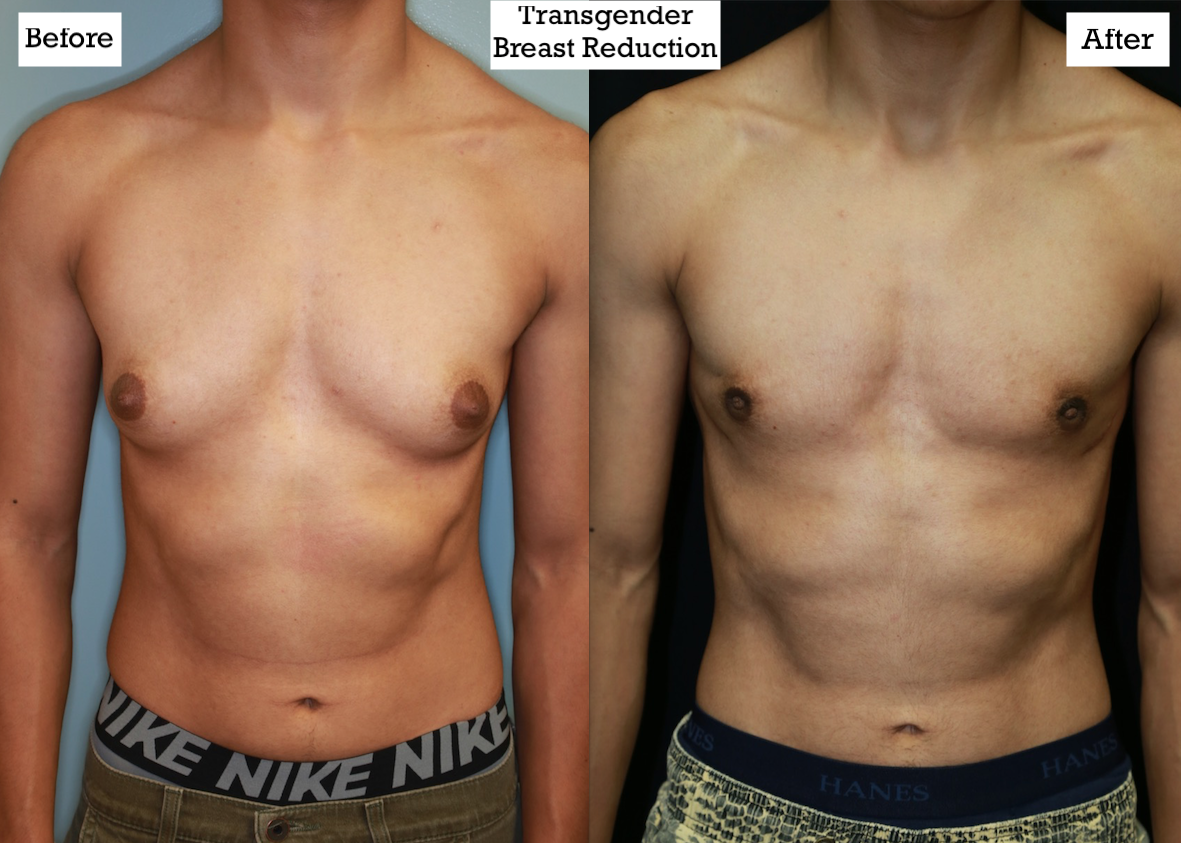 Transgender Female to Male